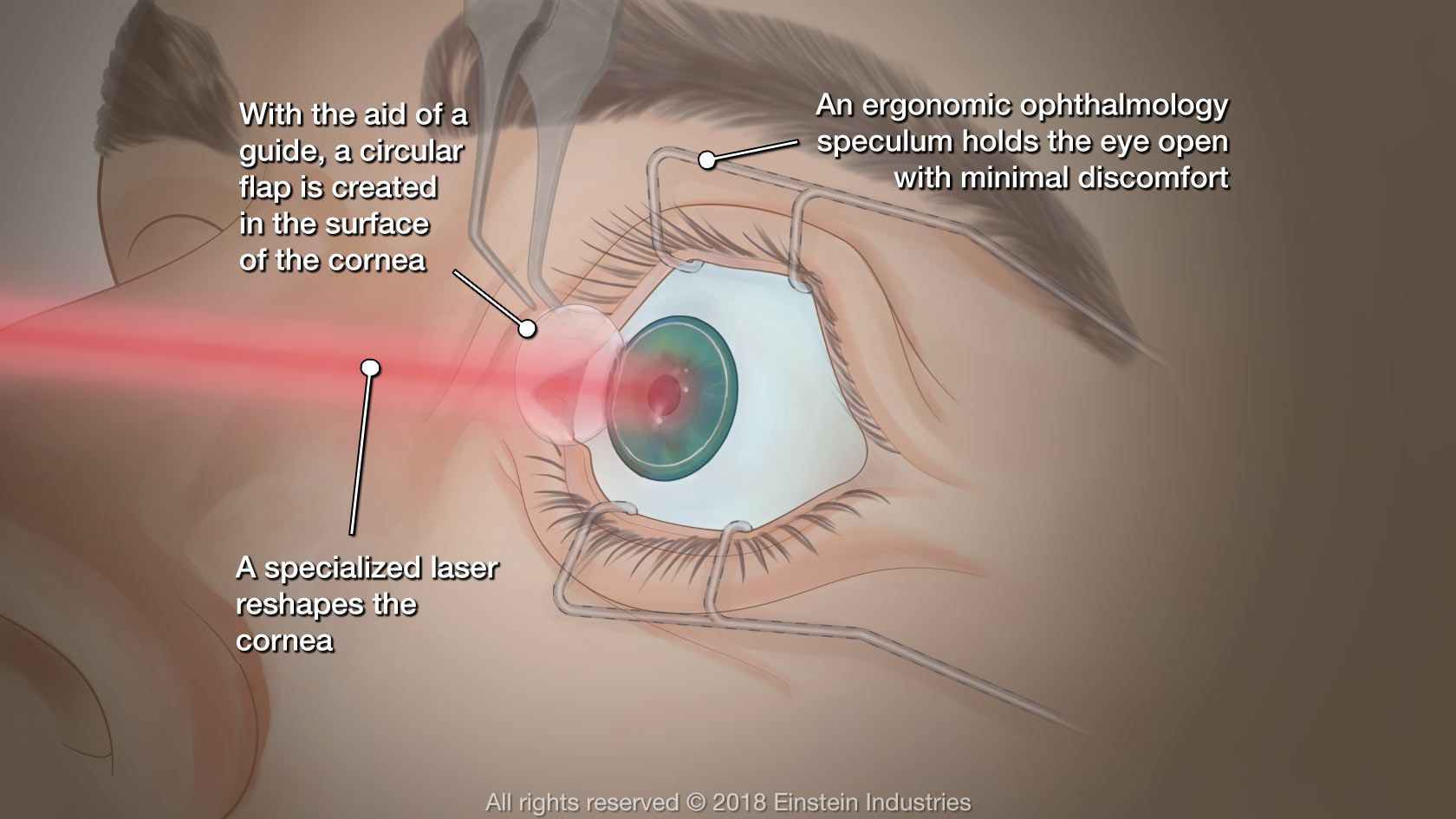Common fears associated with eye surgery Lasik