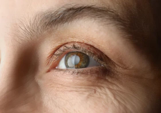 laser eye surgery