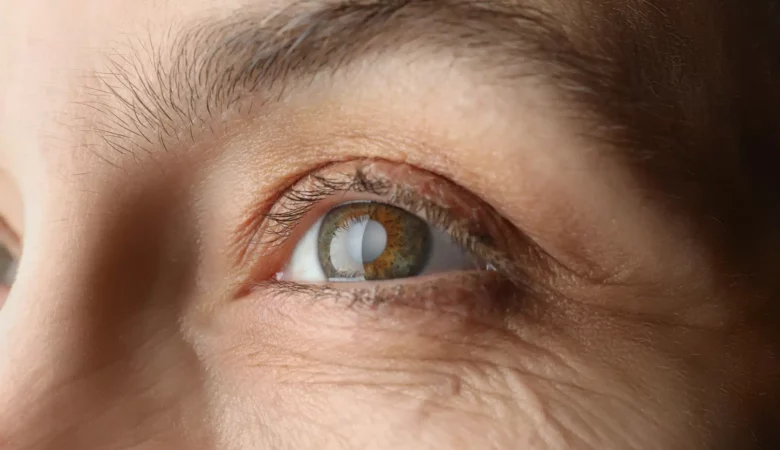 laser eye surgery